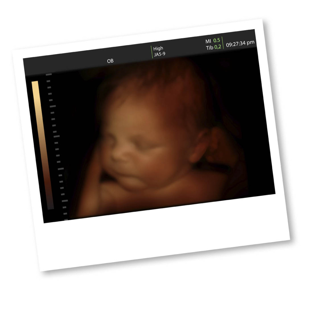 Understanding 2d And 3d Pregnancy Ultrasounds Interna 